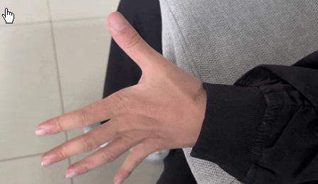 <strong>高中生左手莫名发抖半年确诊平山病</strong>